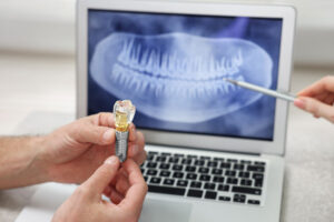 A dental professional holds a dental implant model while pointing at a dental X-ray on a laptop screen.